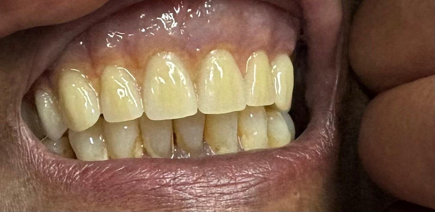 Patient before full denture replacement treatment in Melbourne