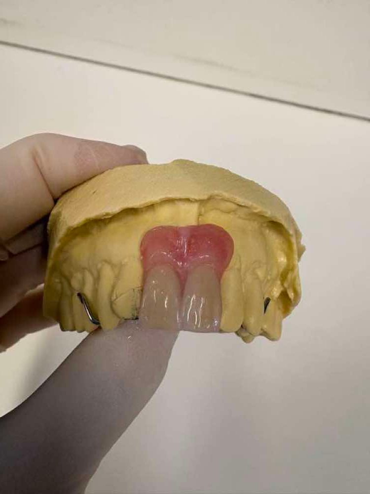 Partial Dentures