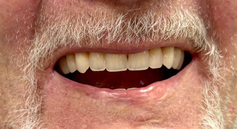Patient smiling confidently with natural-looking dentures at Oak Park Dental & Denture Clinic Melbourne