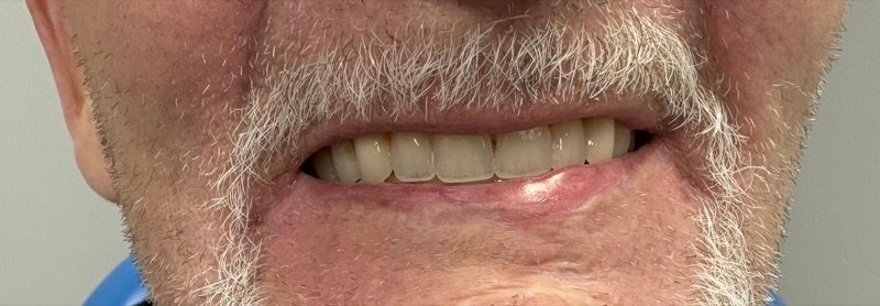 Happy patient with comfortable full dentures showing restored smile and confidence Oak Park